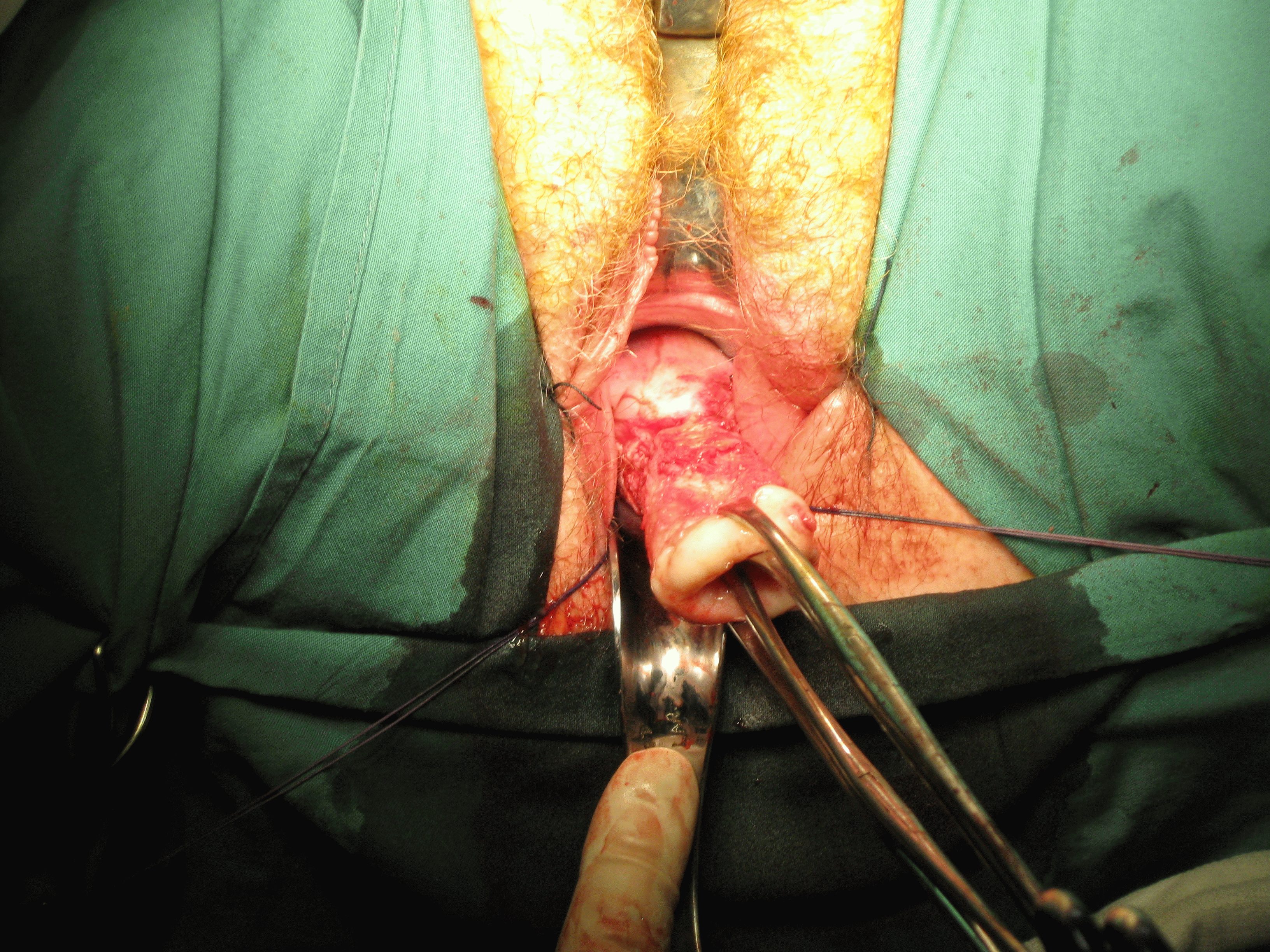 vaginal hysterectomy menorrhagia1